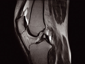 Sequenza FSE T2 sagittale del ginocchio